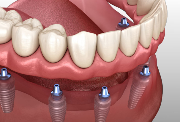 full mouth dental implants