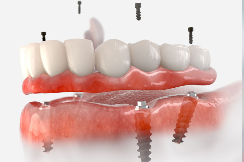 full arch dental implants model
