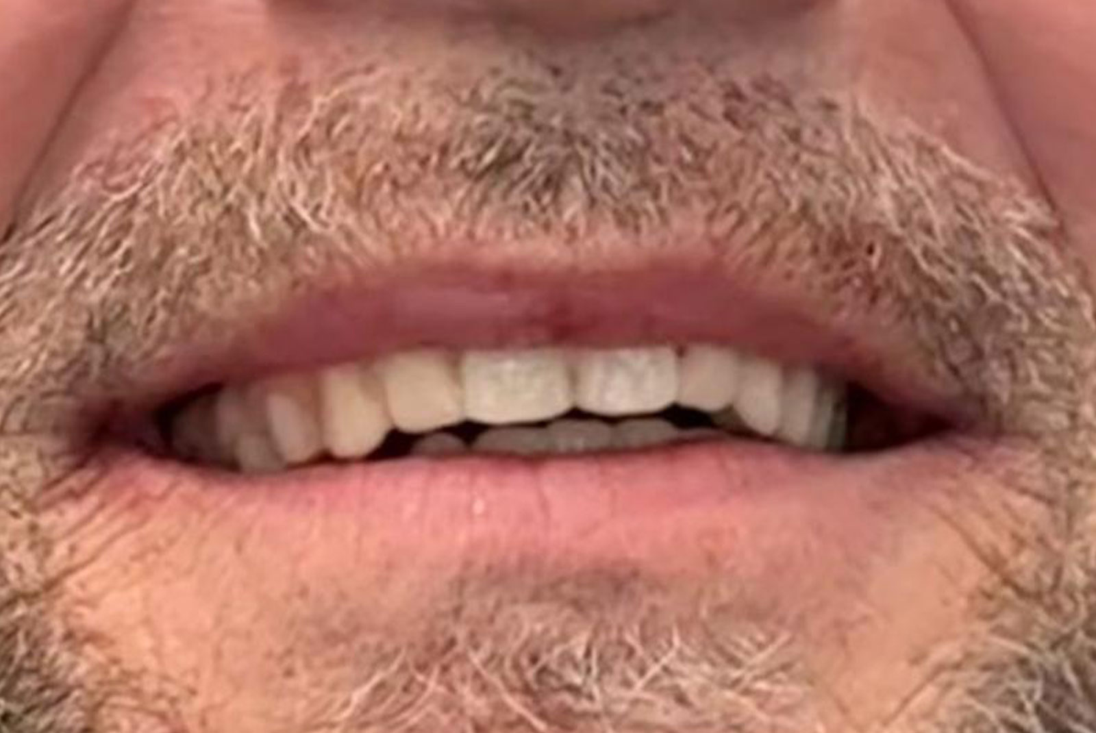 up close before and after dental procedure