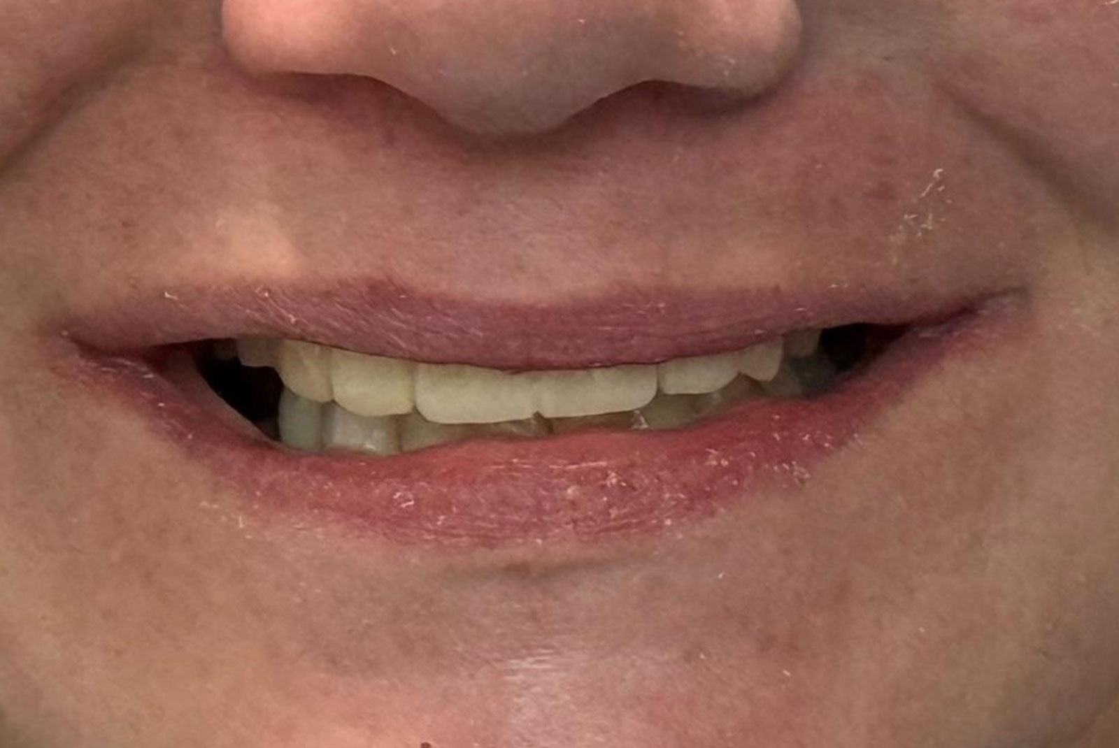 up close before and after dental procedure
