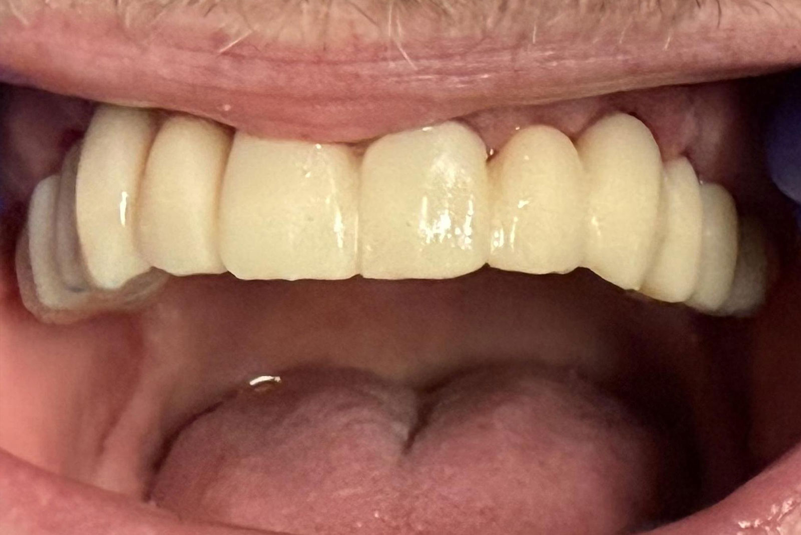 up close before and after dental procedure