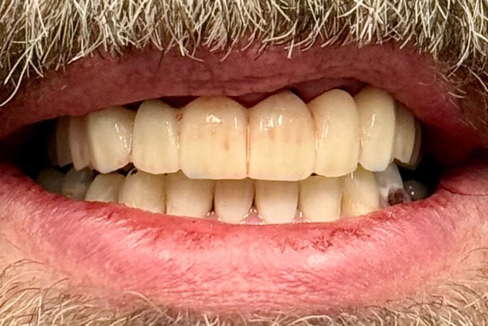 up close before and after dental procedure