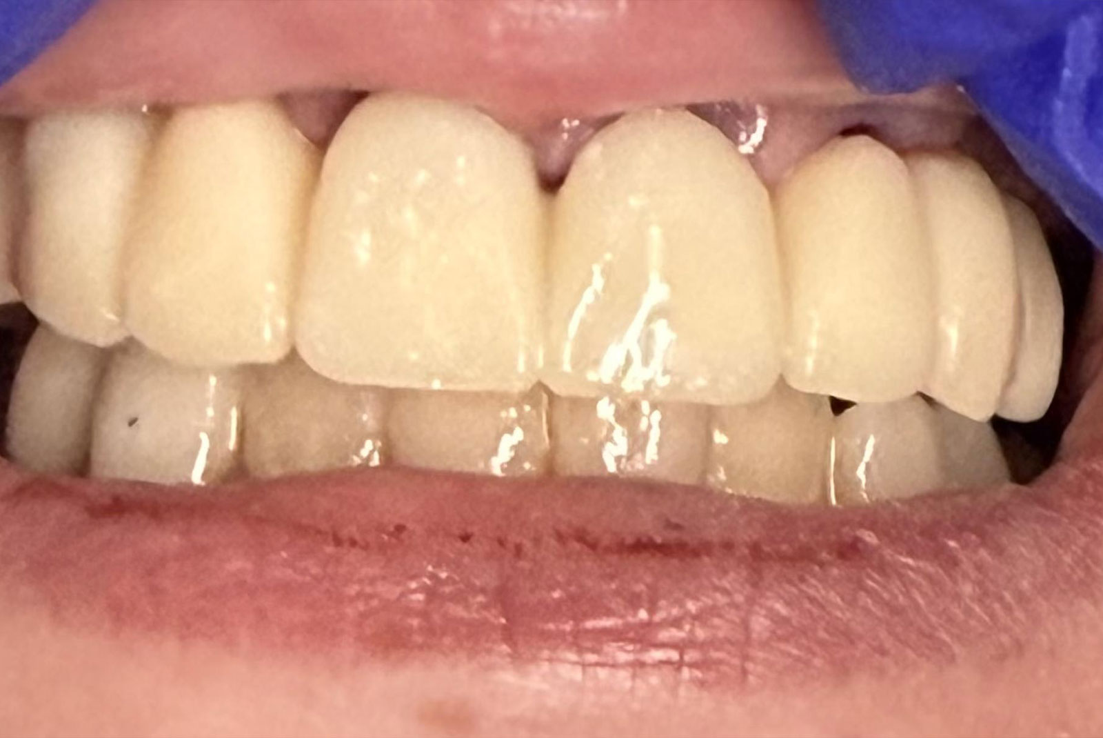 up close before and after dental procedure