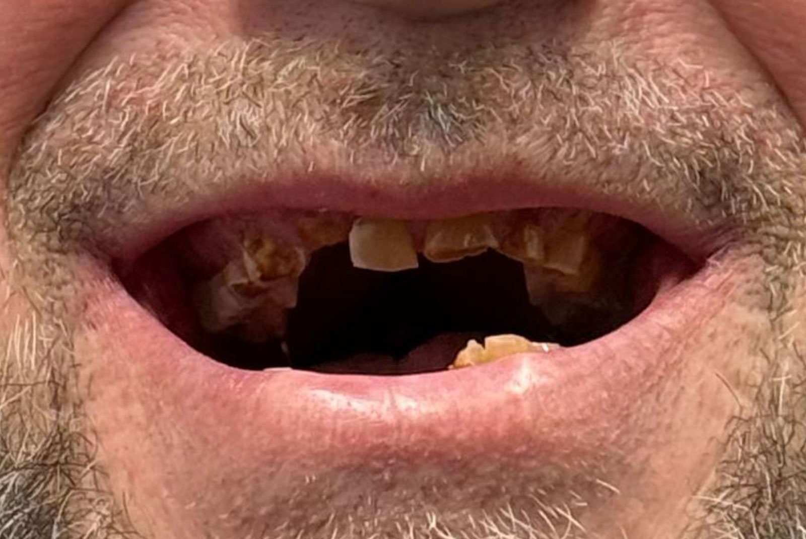 up close before and after dental procedure