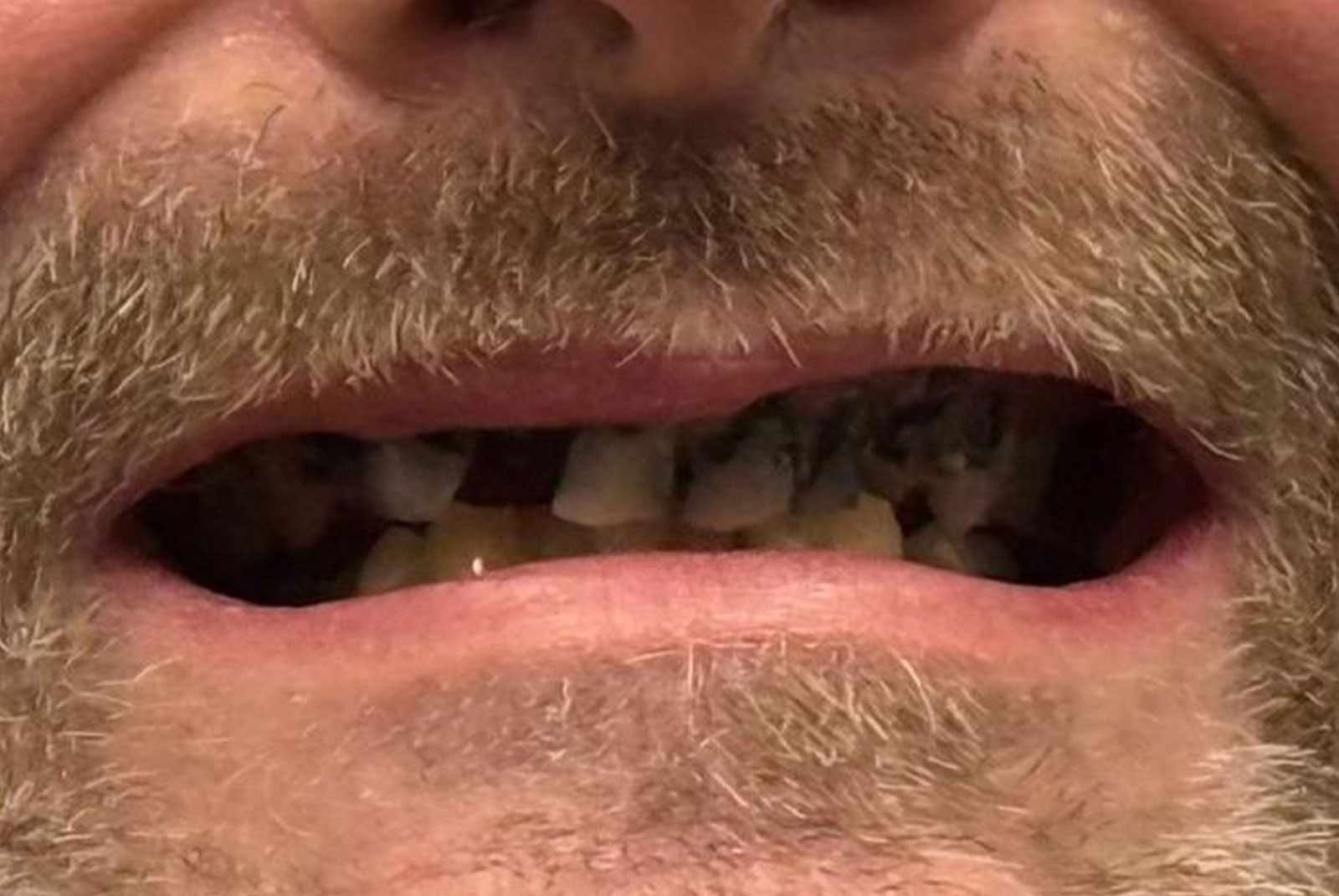 up close before and after dental procedure