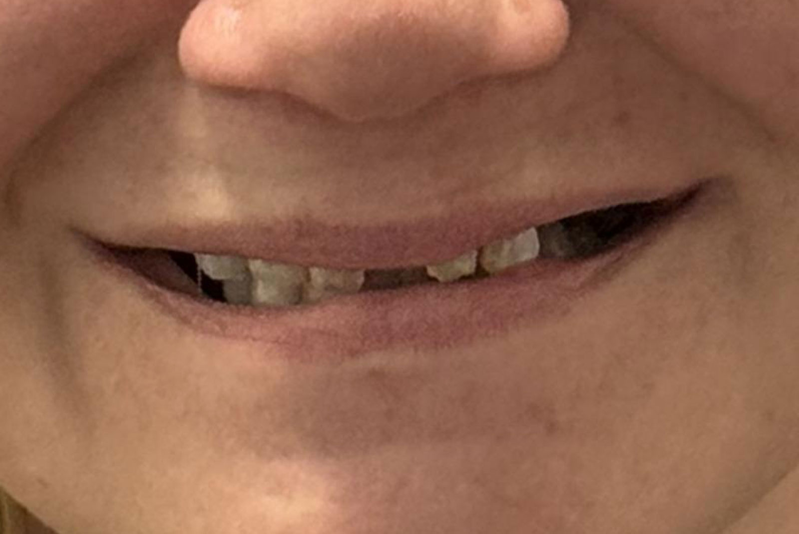 up close before and after dental procedure