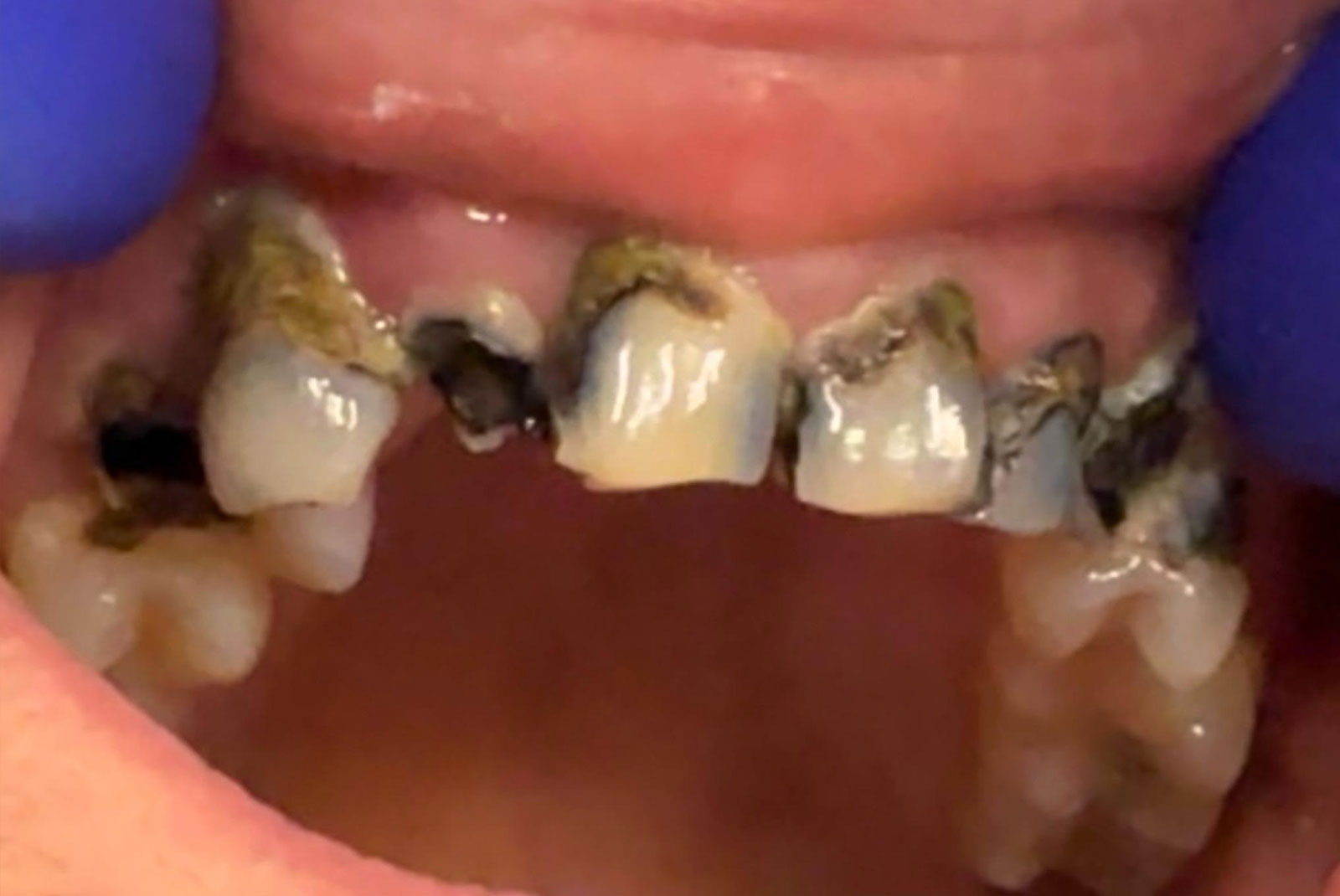 up close before and after dental procedure