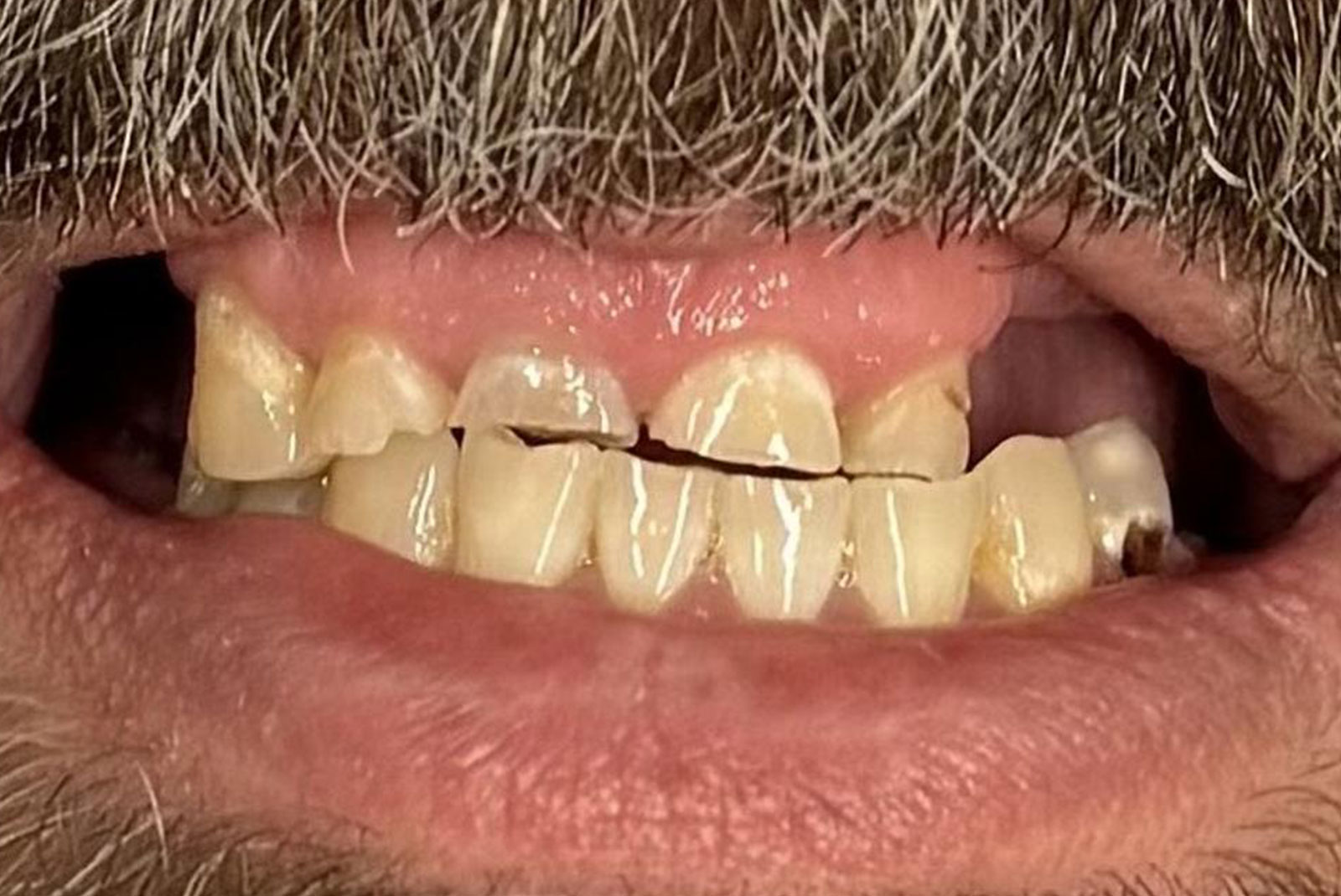 up close before and after dental procedure