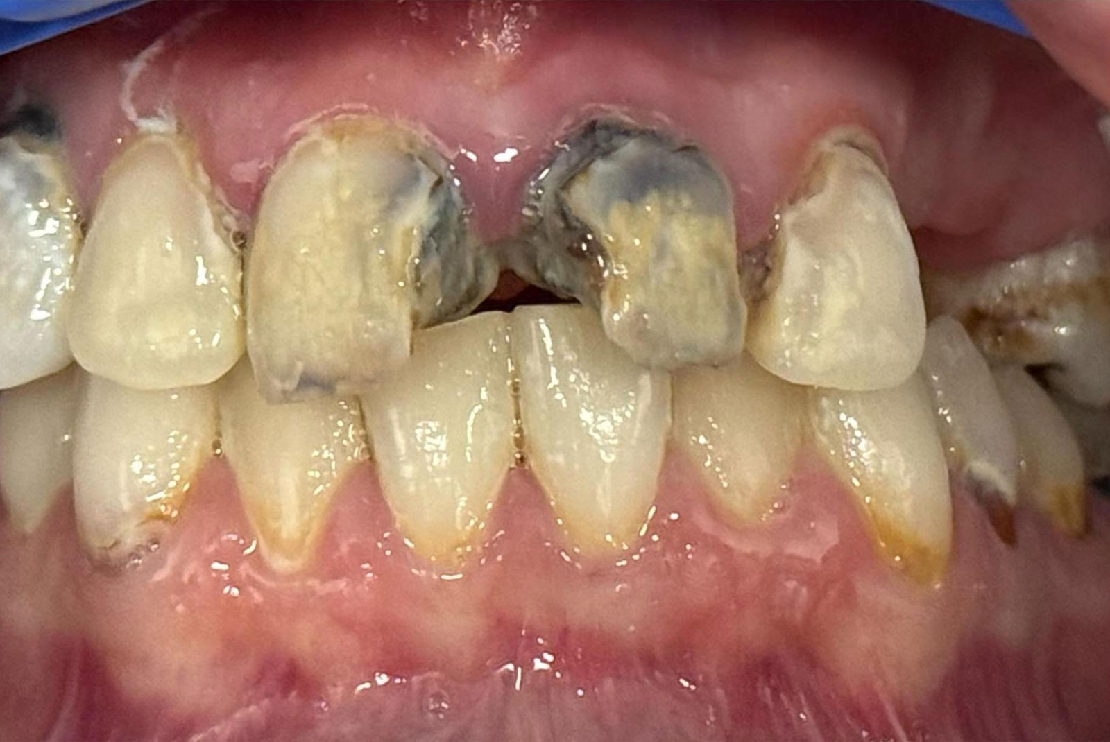 up close before and after dental procedure