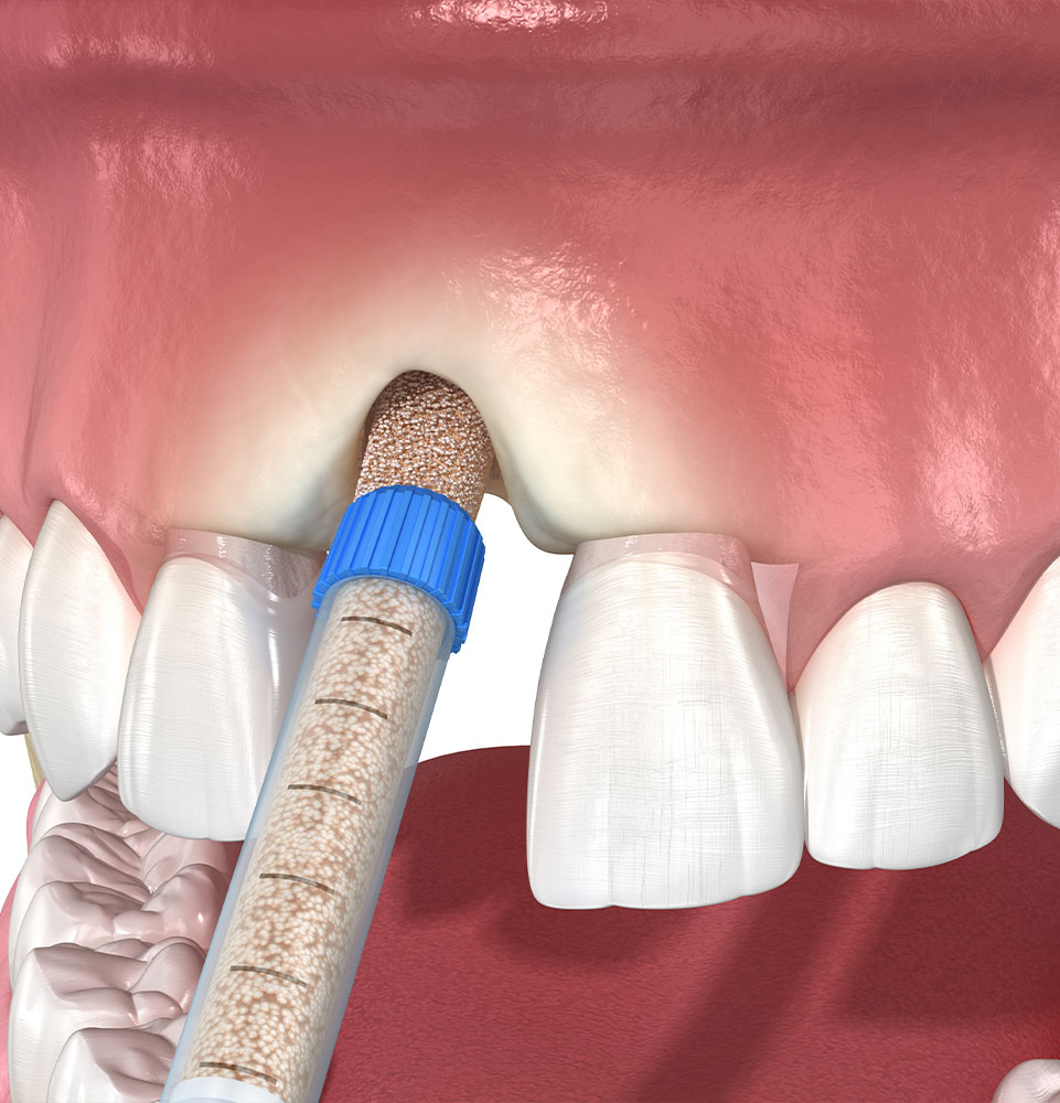 Bone grafting augmentation, socket preservation, tooth implantation