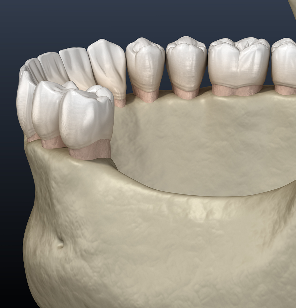 Mandibular Jaw and bone recession after losing molars teeth
