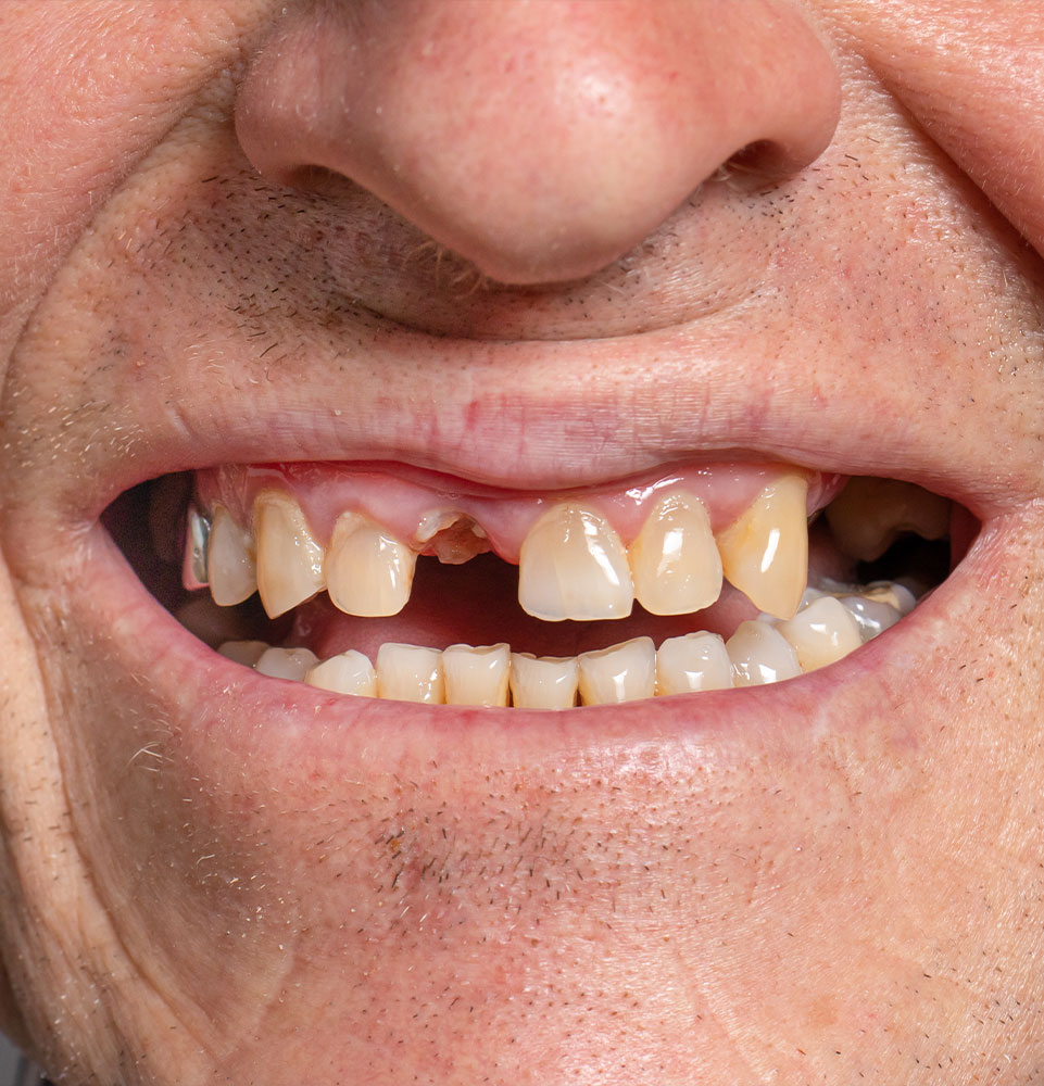 toothless smile of an old European man on a gray background