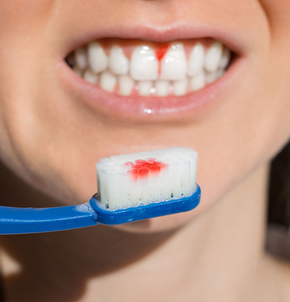 Close up of woman mouth with bleeding gums during teeth brushing.