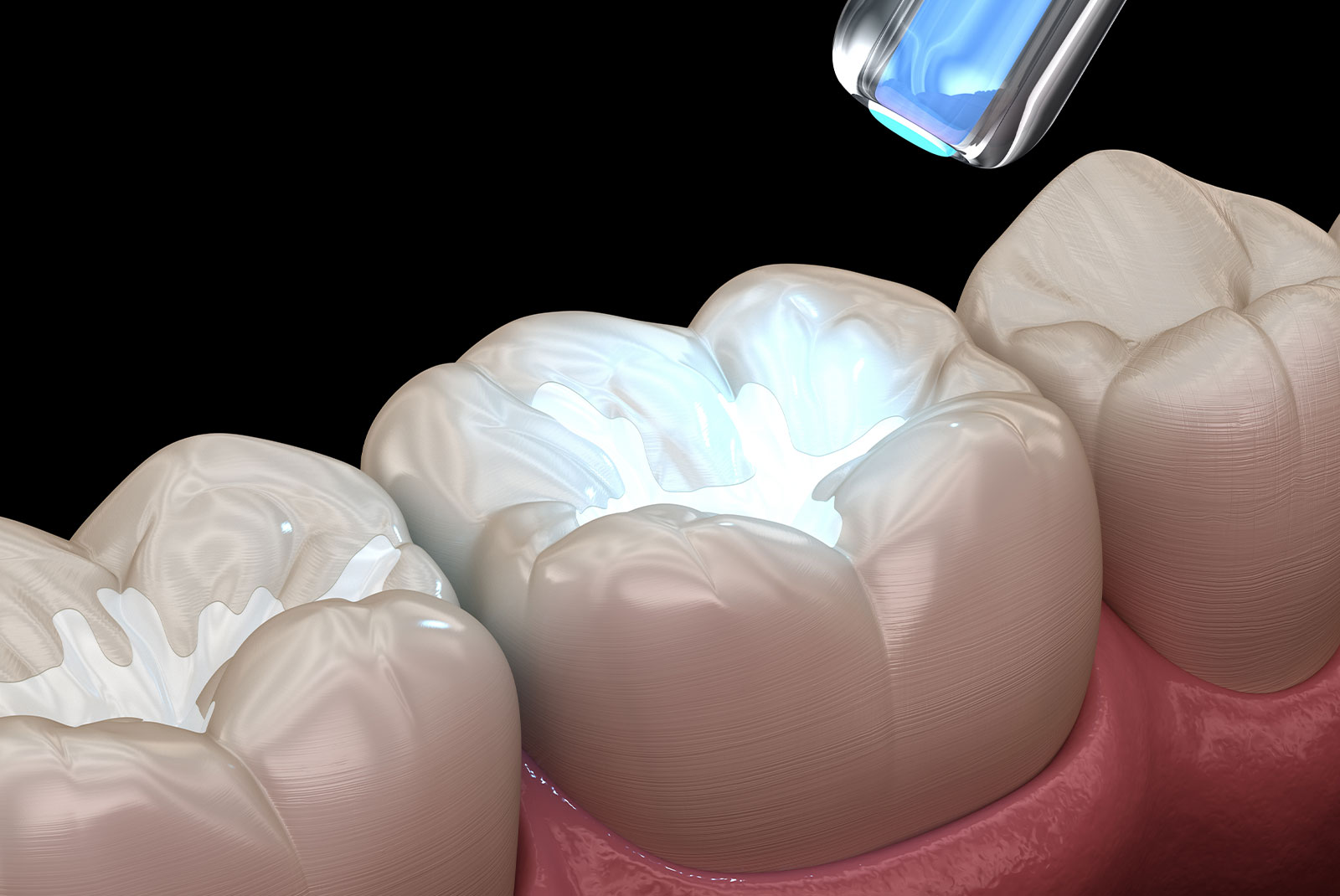 Tooth restoration with filling and polymerization lamp. Medically accurate tooth 3D illustration.