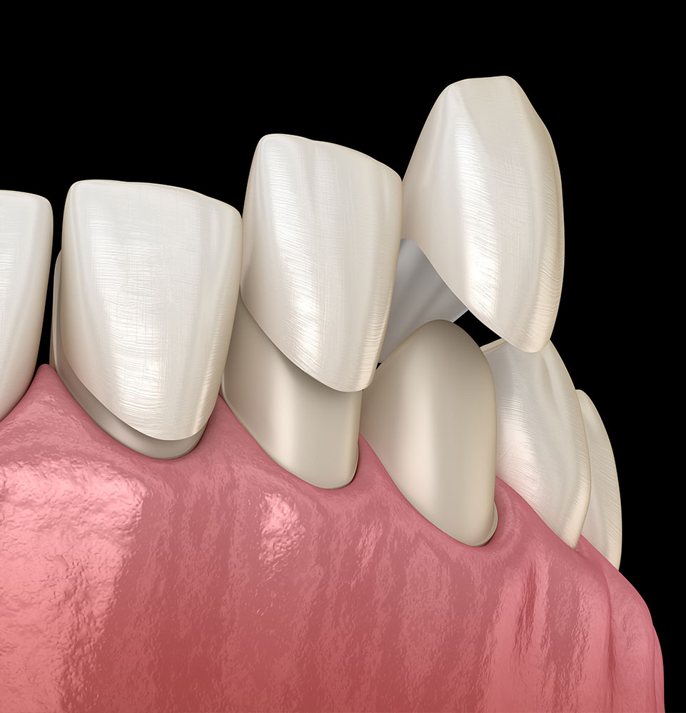 illustrated dental veneer model